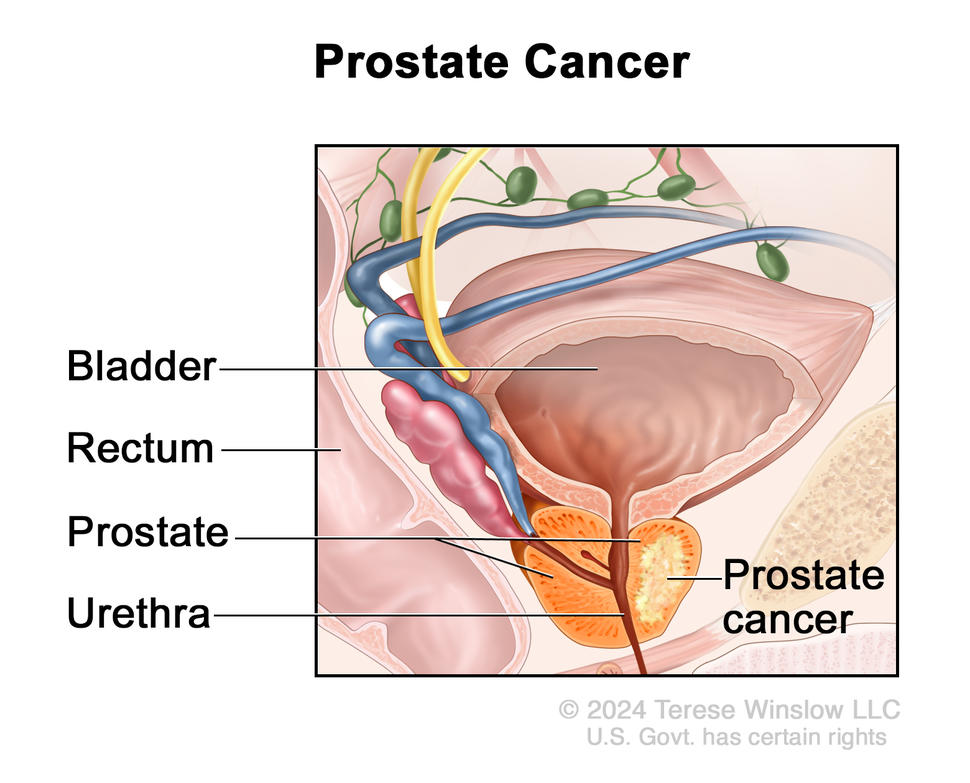UNDERSTANDING PROSTATE CHANGES visual data 4